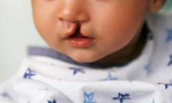 MS Saúde realiza primeira cirurgia de fissura lábio-palatal