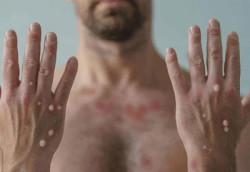 OMS avalia se mpox deve voltar a ser declarada emergência global