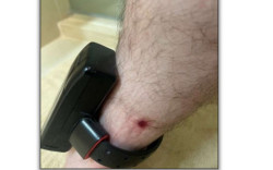 Ex-vereador quer dormir em fazenda e diz que tornozeleira causa ferida na perna