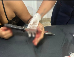 Mulher que teve faca cravada na mão pelo ex-marido tem alta do hospital