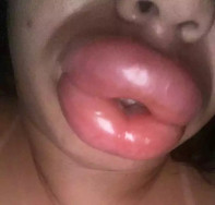 Falsa biomédica que deformou boca de pacientes é indiciada por quatro crimes