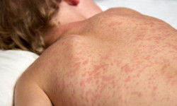 Busca ativa por casos de sarampo é intensificada com apoio do Ministério da Saúde