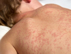 Governo intensifica vacinação para barrar avanço do sarampo em MS