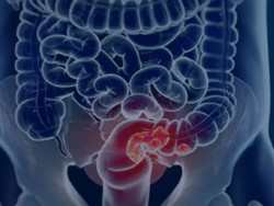 Estudo projeta aumento de 36% em mortes por câncer colorretal até 2040