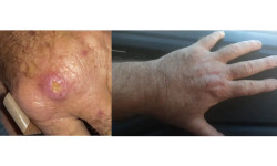 Especialistas alertam para a falta de informação sobre a leishmaniose