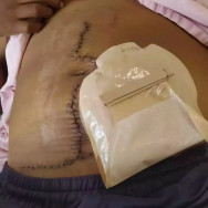 Maternidade do HU-UFGD “esquece” gaze dentro do corpo de mulher durante parto