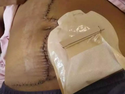 Maternidade do HU-UFGD “esquece” gaze dentro do corpo de mulher durante parto