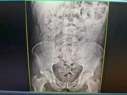 Bolivianos são flagrados com 645 cápsulas de cocaína no estômago