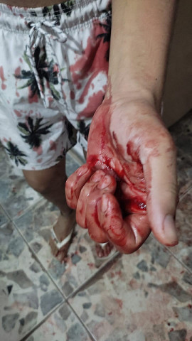 Vítima foi golpeada na mão por bandidos (Imagem: Adilson Domingos)