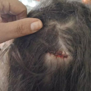 Criança de 7 anos é atingida na cabeça por tiro de raspão enquanto dormia na Capital