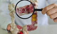 Em 13 anos, doença inflamatória intestinal cresce 5 vezes no Brasil