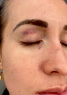 Fotografias feitas durante exame de corpo de delito comprovam as agressões físicas do vereador Diogo Castilho contra a vítima Thaís Carlos Ponce - Foto: Reprodução