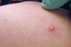 MS confirma 3 novos casos de varíola dos macacos; dois são de Dourados