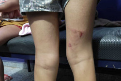 Marcas na criança em Chapadão do Sul (Foto: Divulgação)