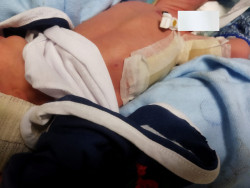 Recém-nascido sofre queimaduras em incubadora no HU de Dourados