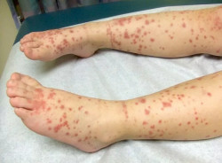 Brasil tem 49 registros de febre maculosa em 2023, com seis mortes